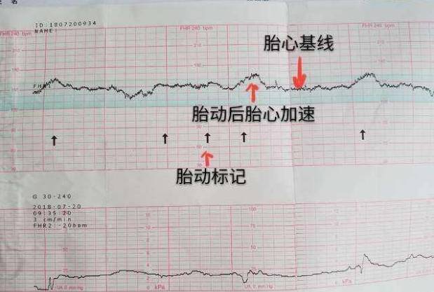 胎心率可判断胎儿情况
