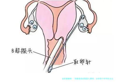 预算泰国试管婴儿费用：分析每个环节的支出与选择