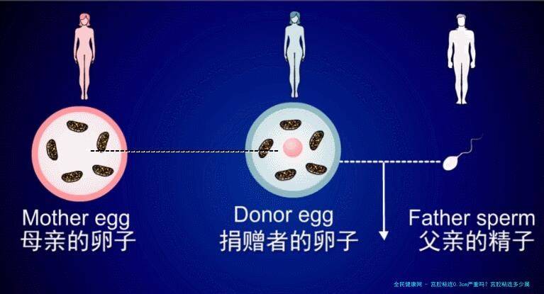 宫腔粘连0.3cm严重吗？宫腔粘连多少属于轻度？