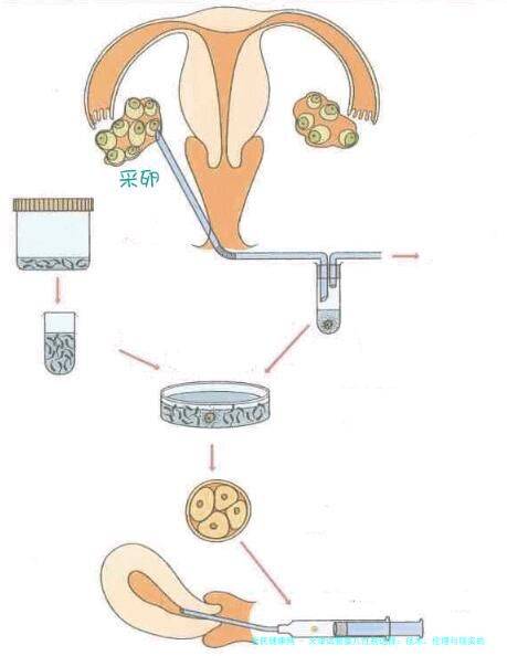 天津试管婴儿**：技术、伦理与现实的博弈