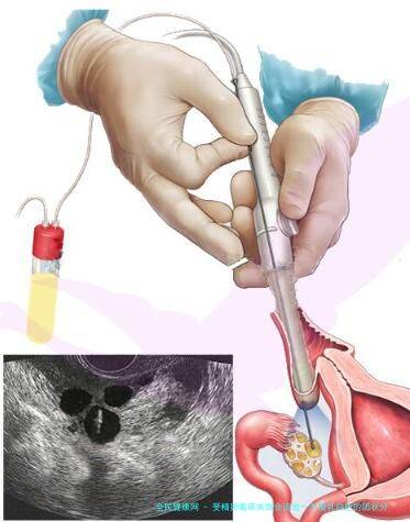 受精卵着床失败会流出一大股乳白色的团状分泌物吗?