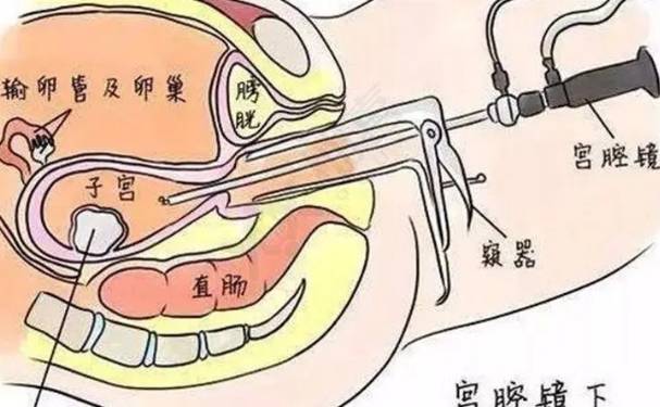 宫腔镜手术需要麻醉