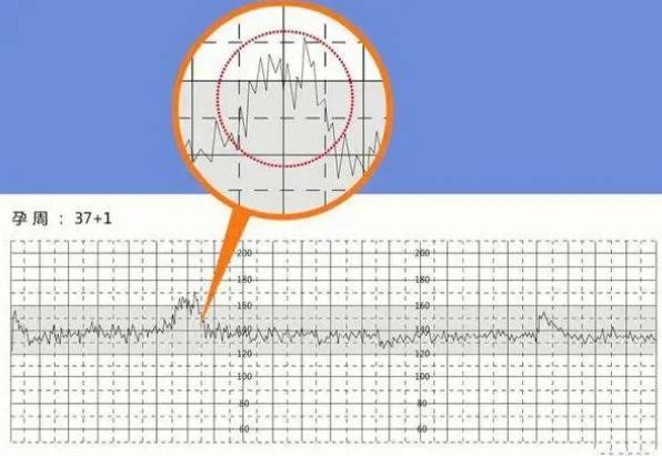 监护结果要看胎心率