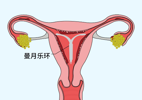 曼月乐环可抑制子宫疾病