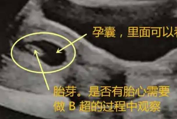 40天孕囊平均直径约为 ‌10-15毫米