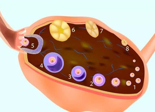黄体期促排失败可能是由卵巢包膜导致的
