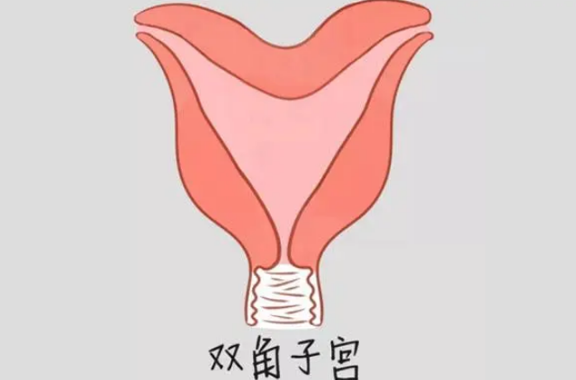 双角子宫患者可以做试管婴儿