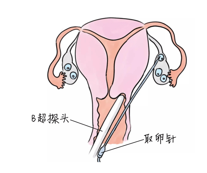 B超看到多少卵，就能取到多少卵吗？