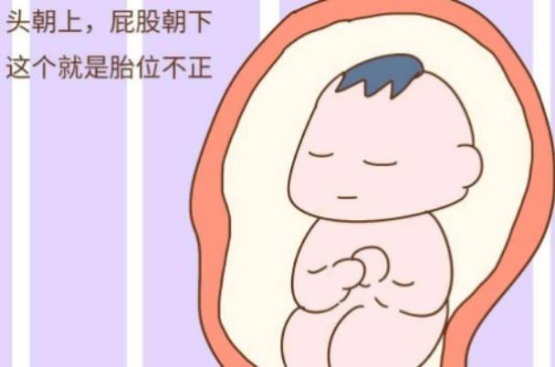 胎位不正容易导致难产