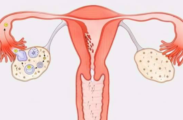 多囊卵巢可以尝试中药治疗，优势不止一方面