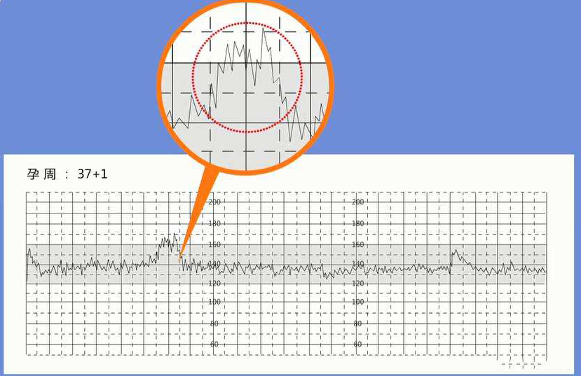 孕晚期胎心率170次/分孕妇怀的**还是女孩？