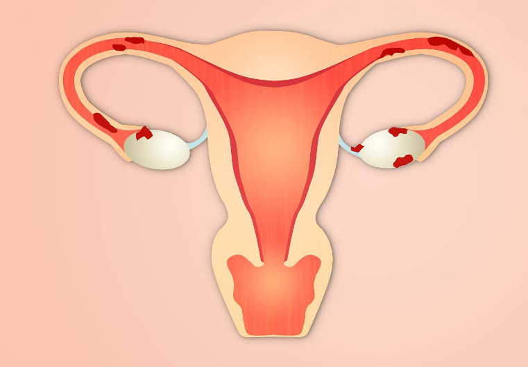 盘点治疗多囊卵巢的正规医院，这几家机构都值得推荐