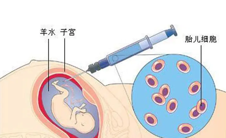 孕妇羊水穿刺后坐班不影响，保证合理坐姿没有问题