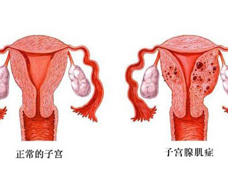 女性疾病科普：子宫腺肌症症状、病因、治疗等