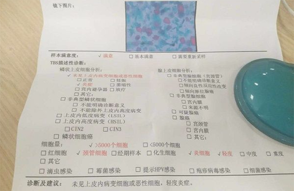 正常tct检查报告单的结果该怎么看，有图片分享吗？