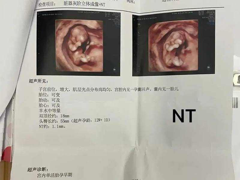 NT数值在2.5mm以下是正常的