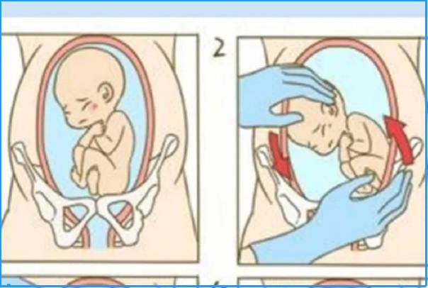 孕妇胎位不正可以用外倒转术
