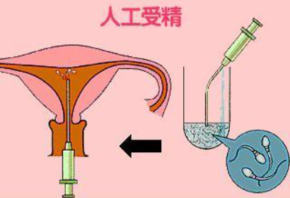 详解**人工授精的流程和费用，你想知道的都在里面！