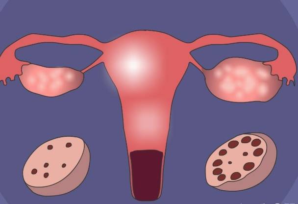 什么人容易得多囊卵巢综合症，饮食不健康者要当心