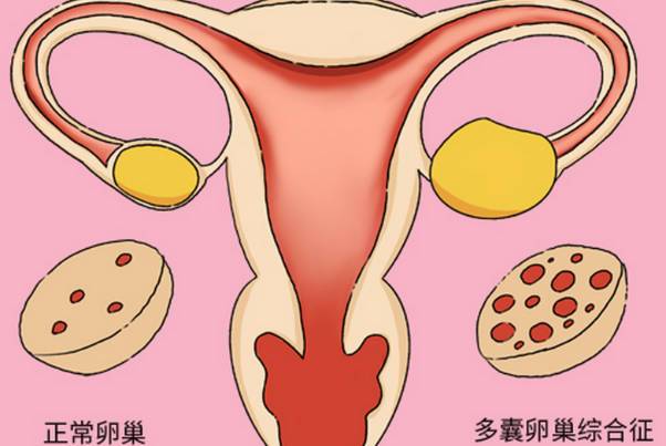 多囊卵巢为什么要吃坤泰胶囊，有无治疗效果深度剖析