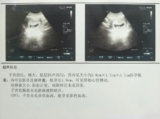 双肾未见明显分离并不一定是**