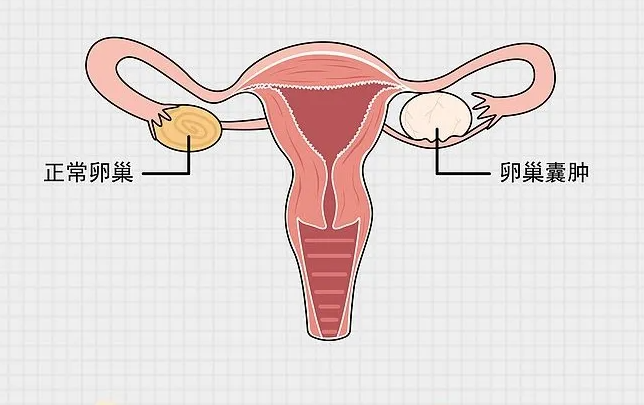 卵巢囊肿是怎么回事？看完你就明白了！
