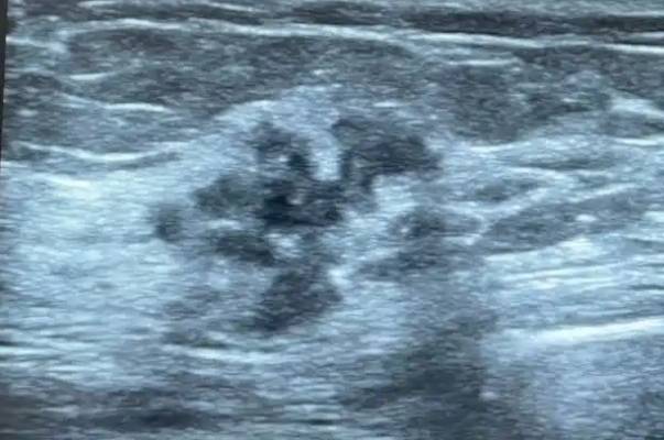 医院类型会影响乳腺彩超的价格