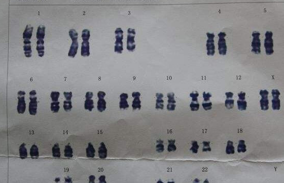 染色体47XXX是一种染色体异常情况