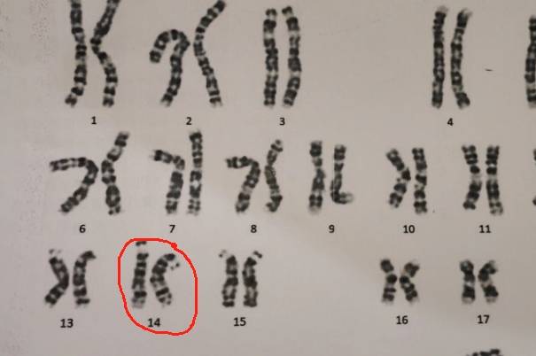 14号染色体异常智力会受限