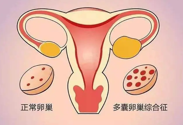 双侧卵巢多囊样改变有可能是药物引起的