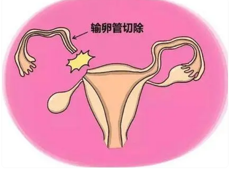 [女人输卵管切除一边还能生育吗？]