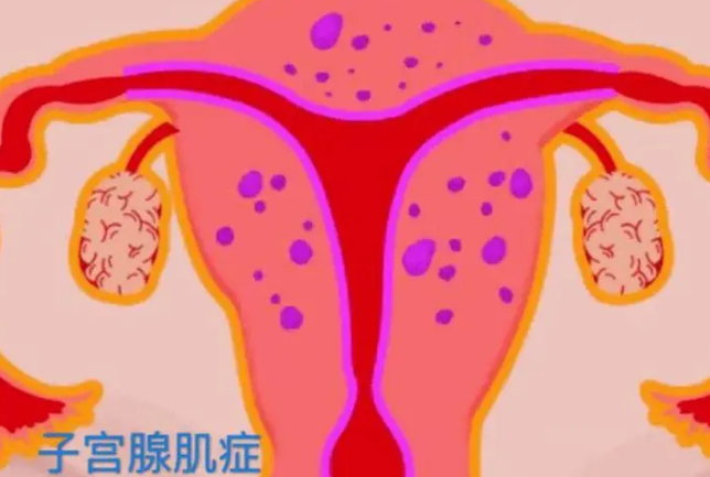 分别患有子宫腺肌症和卵巢早衰的女性能做试管婴儿怀孕吗？