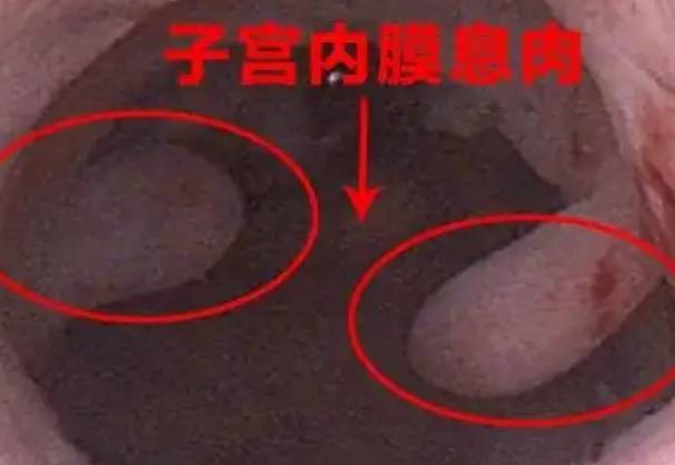 内膜息肉10×6mm不严重