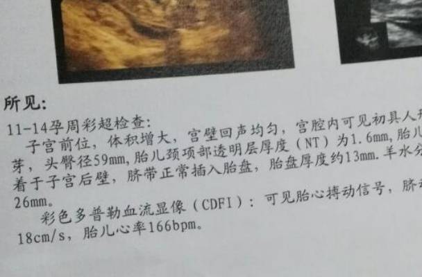 孕12周nt值2.5mm孩子发生畸形的几率大吗？