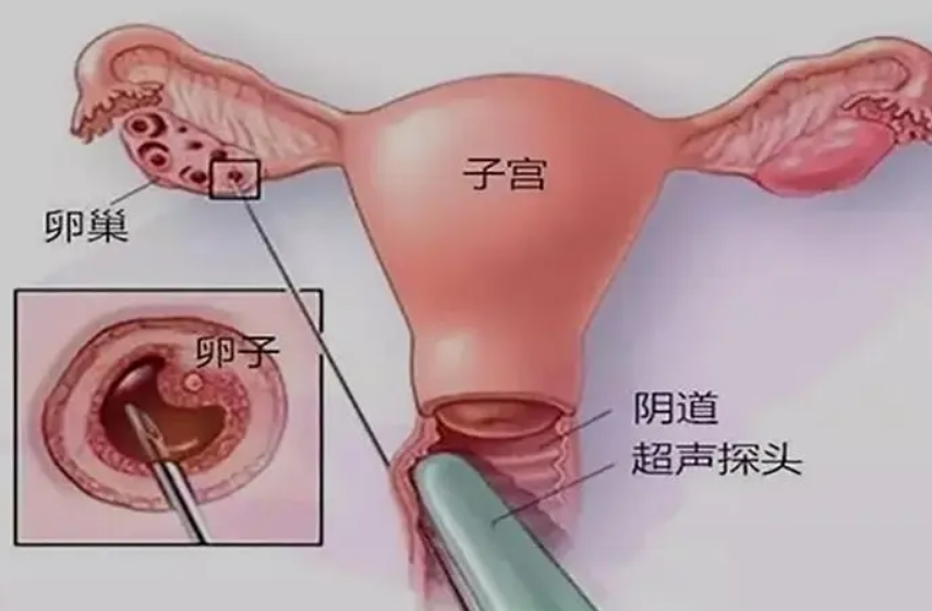 试管婴儿详情告知单上的opu是什么意思？