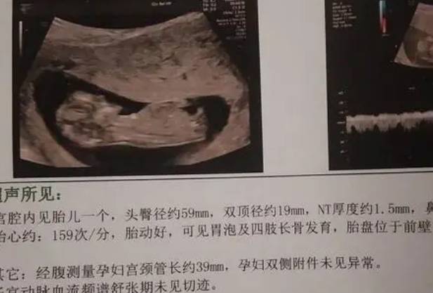 孕12周nt检查结果值小于1.5怀的就一定是女儿吗？