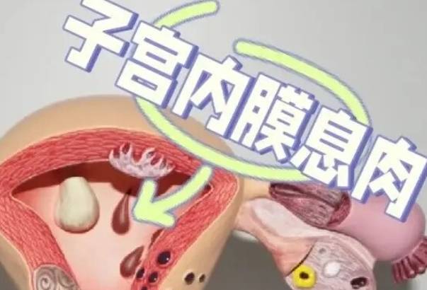 子宫内膜息肉会影响生育能力