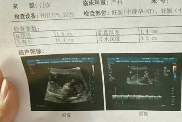 已**宝妈妈认为孕13周NT数值小于1.6mm是**还是女孩，本文将揭晓答案