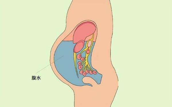 取出卵子后排腹水的八大绝招分享，调整饮食是关键