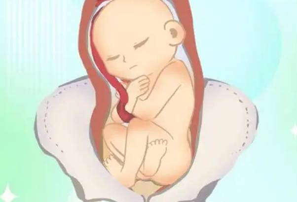 胎儿臀位与脑部畸形无关