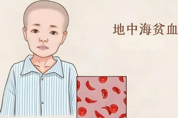 地中海贫血患者建议选择做试管婴儿