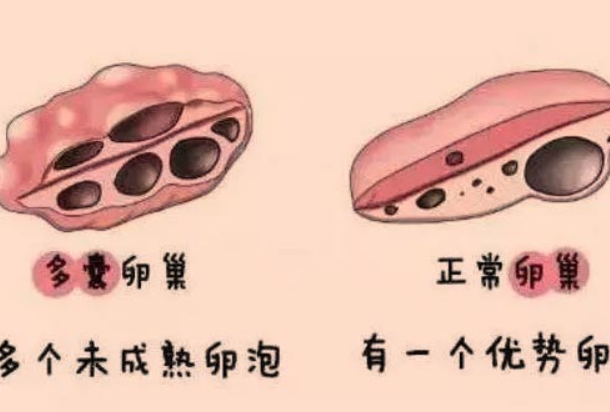 37岁多囊想要**但自然受孕几率低可以做试管吗？