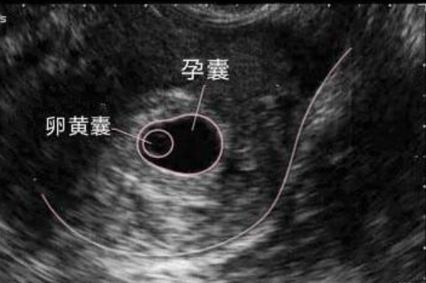 hcg和卵黄囊一样重要