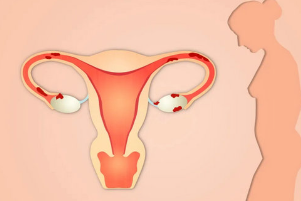 内膜异位症重则可导致不孕！治疗方法其实不止手术这一种