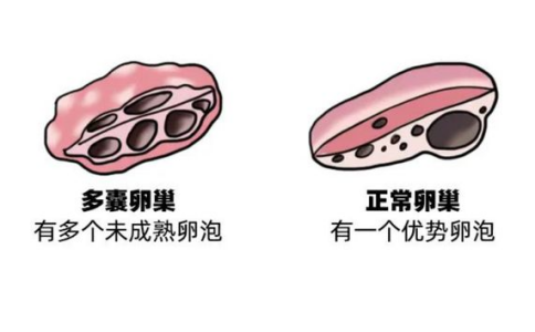 多囊​卵巢能怀孕吗？会不会遗传