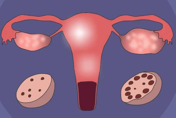 卵泡不破综合症的4大治疗方法汇总，调理好也能治愈