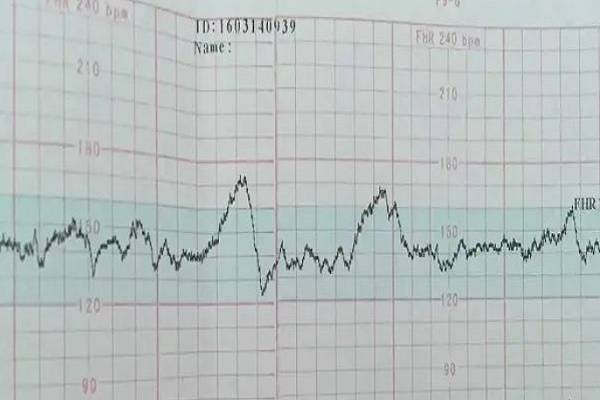 胎心率看胎儿性别的方法介绍，150以上是**孩