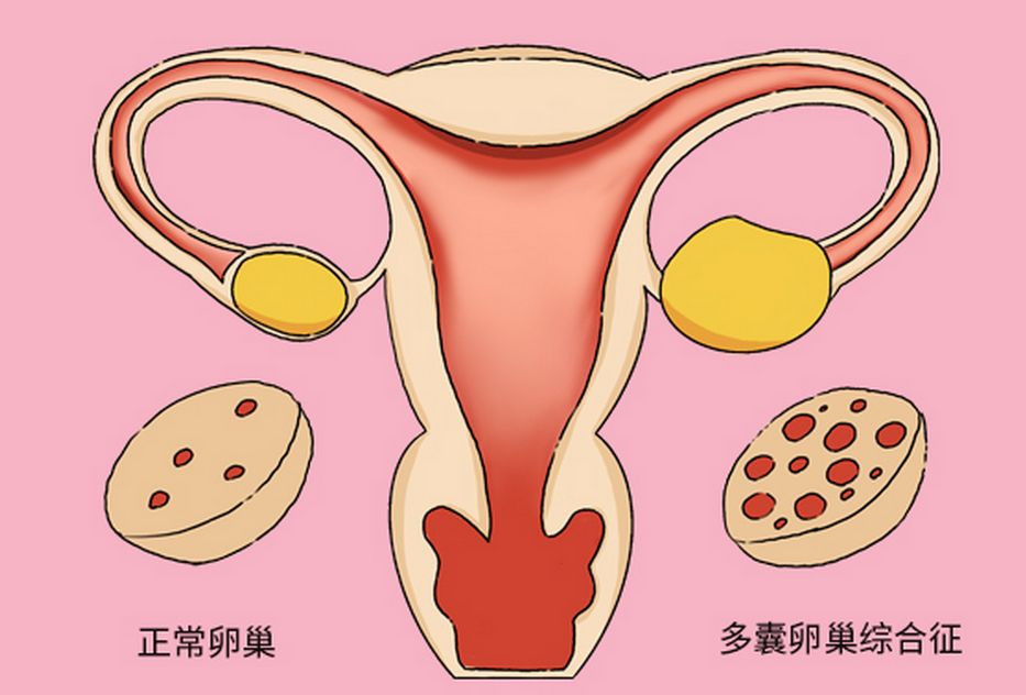 多囊卵巢综合症导致不孕，可以通过做试管来助孕吗？