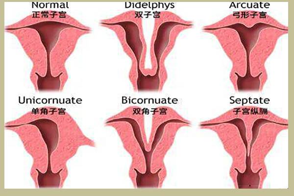 女性子宫畸形的形状呈不规则形