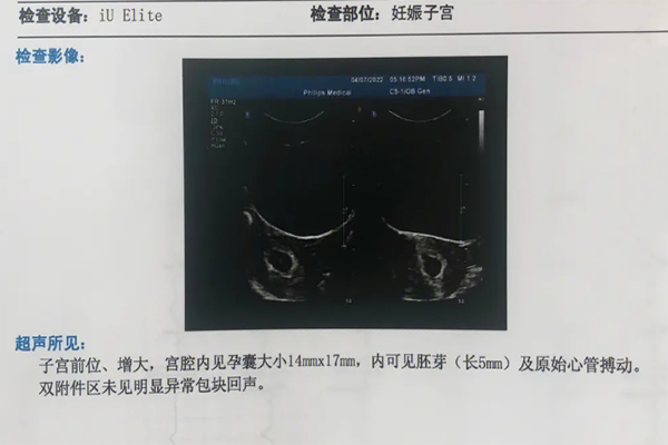 孕7周通过胎囊2个数值看**的性别准不准确呢?